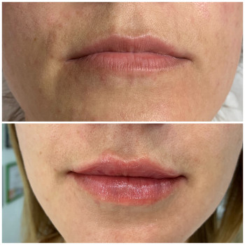 Контурна пластика губ