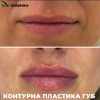 Контурна пластика губ