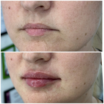 Контурна пластика губ