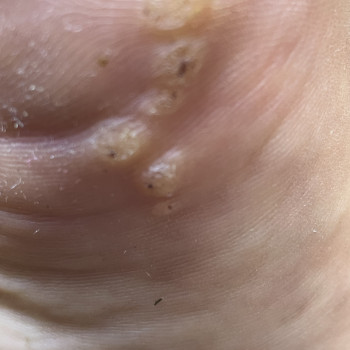 Первинна обробка бородавки (1-2 шт)
                    Центры подологии Calutte Харьков