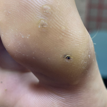 Первинна обробка бородавки (1-2 шт)
                    Центры подологии Calutte Харьков