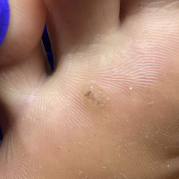 Первинна обробка бородавки (1-2 шт)
                    Центры подологии Calutte Харьков