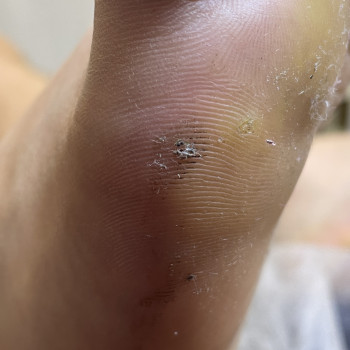 Первинна обробка бородавки (1-2 шт)
                    Центры подологии Calutte Харьков