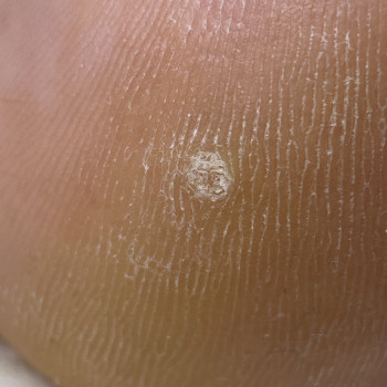 Первинна обробка бородавки (1-2 шт)
                    Центры подологии Calutte Харьков