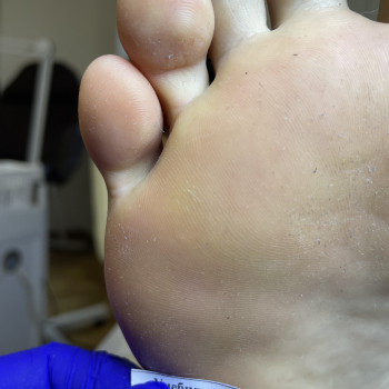 Первинна обробка бородавки (1-2 шт)
                    Центры подологии Calutte Харьков