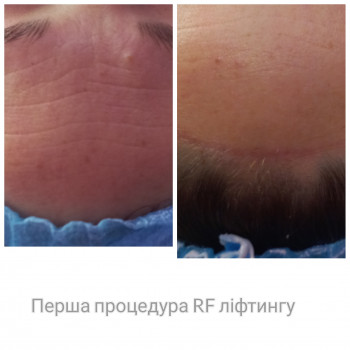 Rf ліфтинг + Електропорація
                    Косметолог Лілія Винница
