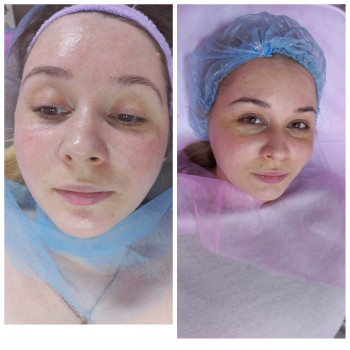 Rf ліфтинг + Електропорація
                    Косметолог Лілія Винница