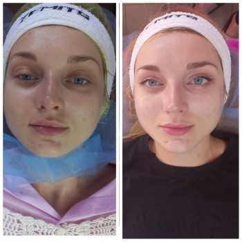 Rf ліфтинг + Електропорація
                    Косметолог Лілія Винница