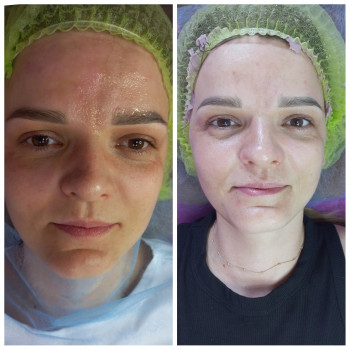 Rf ліфтинг + Електропорація
                    Косметолог Лілія Винница