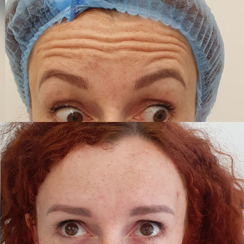 Ботулінотерапія, корекція мімічних зморшок