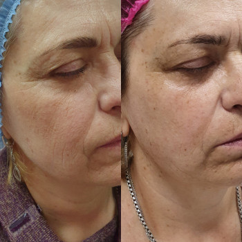 Біоревіталізація