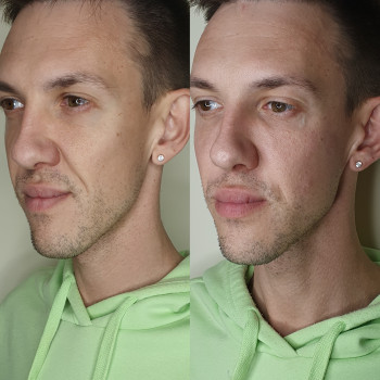 Контурна пластика скули
                    Лікар-косметолог Оксана Київ