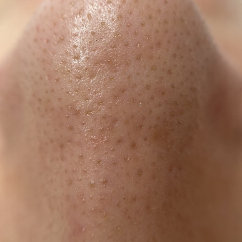 Ніс після процедури