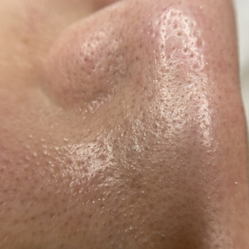 Ніс після процедури