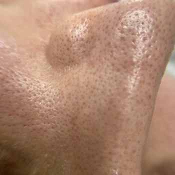 Ніс до процедури