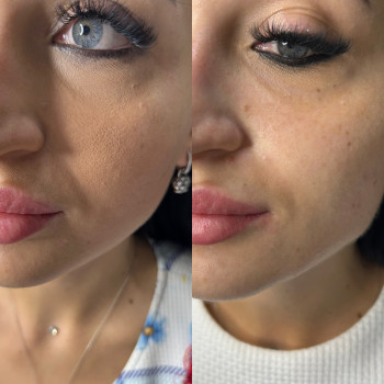 Ліфтинг та зволоження за 2 процедури, фото - косметолог-ін'єкціоніст Олена Поліщук