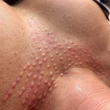 Біоревіталізація зони декольте, фото - косметолог-ін'єкціоніст Олена Поліщук