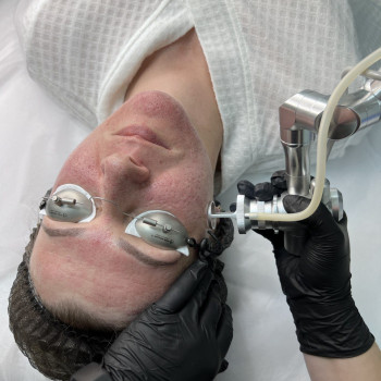 Лазерна шліфовка обличчя