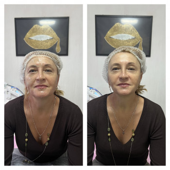 Смас лифтинг HIFU V-MAX
                    Косметолог-эстетист Карина Днепр