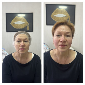 Смас лифтинг HIFU V-MAX
                    Косметолог-эстетист Карина Днепр