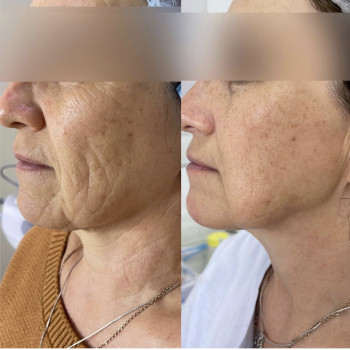 Смас лифтинг HIFU V-MAX
                    Косметолог-эстетист Карина Днепр