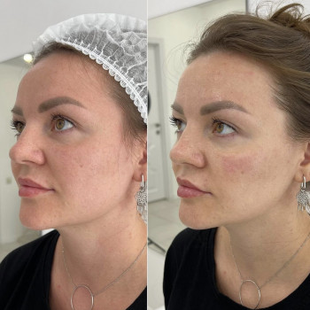 Смас лифтинг HIFU V-MAX
                    Косметолог-эстетист Карина Днепр