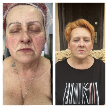 Смас лифтинг HIFU V-MAX
                    Косметолог-эстетист Карина Днепр