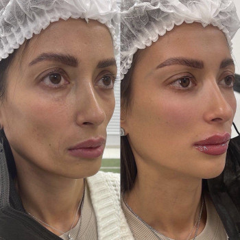 Смас лифтинг HIFU V-MAX
                    Косметолог-эстетист Карина Днепр