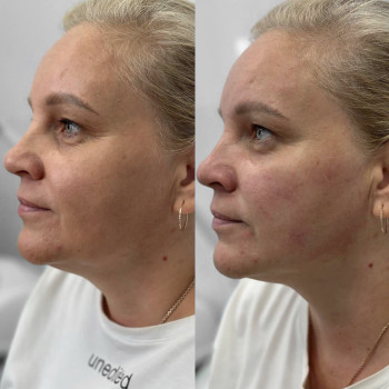 Смас лифтинг HIFU V-MAX
                    Косметолог-эстетист Карина Днепр