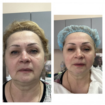 Смас лифтинг HIFU V-MAX
                    Косметолог-эстетист Карина Днепр