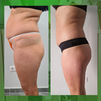 Антицелюлітний масаж
                    Масажист Елена Одеса