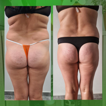 Антицелюлітний масаж
                    Масажист Елена Одеса