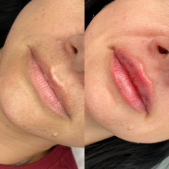 Контурна пластика губ
                    Мастер перманентного макияжа Ольга Житомир