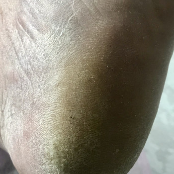 Гіпергідроз, пов‘язаний з внутрішніми хворобами,зайвою вагою