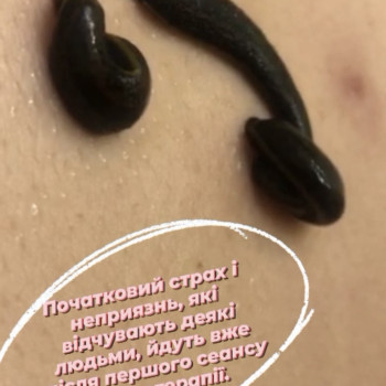 Гірудотерапія
                    Салон краси Імперія краси Кременчук