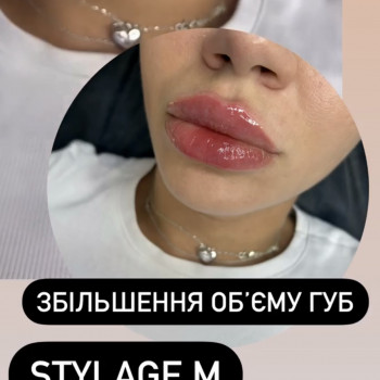 Контурна пластика губ