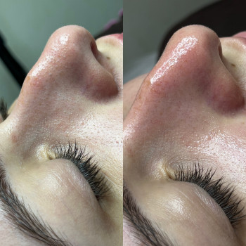 Механічна чистка