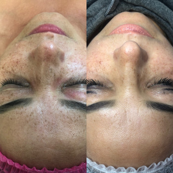 Робота з пігментацією