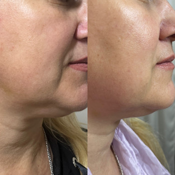 Ліполітики , робота з другим підборіддям