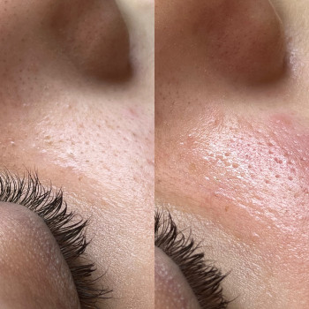 Механічна чистка