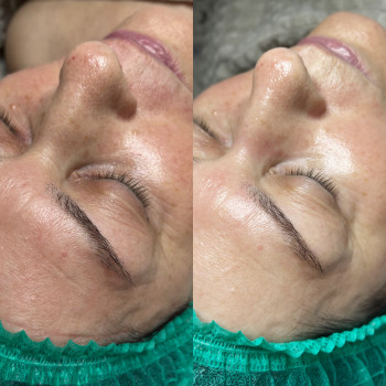 Результат після масажу