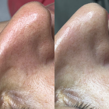 Атравматична чистка