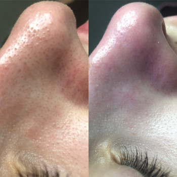 Механічна чистка