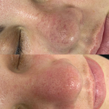 Лазерне видалення судин, судинних зірочок
                    Салон краси Atmosfera Krasu Чернівці