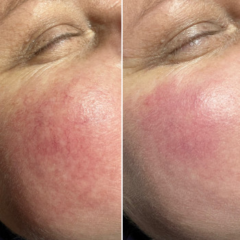 Лазерне видалення судин, судинних зірочок
                    Салон краси Atmosfera Krasu Чернівці