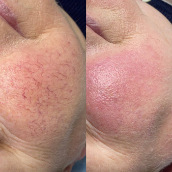 Лазерне видалення судин, судинних зірочок
                    Салон краси Atmosfera Krasu Чернівці