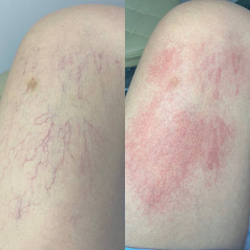 Лазерне видалення судин, судинних зірочок
                    Салон краси Atmosfera Krasu Чернівці