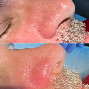 Лазерне видалення судин, судинних зірочок
                    Салон краси Atmosfera Krasu Чернівці