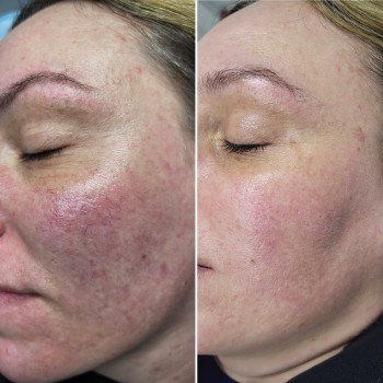 Лазерне видалення судин, судинних зірочок
                    Салон краси Atmosfera Krasu Чернівці