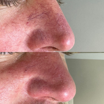 Лазерне видалення судин, судинних зірочок
                    Салон краси Atmosfera Krasu Чернівці